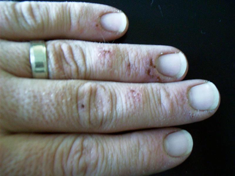 Hand, Injury, Strip Paint