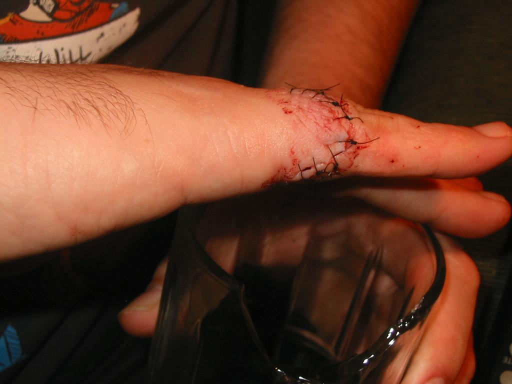 Hand, Human, Not For Dakkadakka, Stitches, Wound